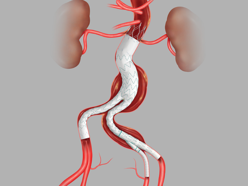 Zenith abdominal endovascular graft