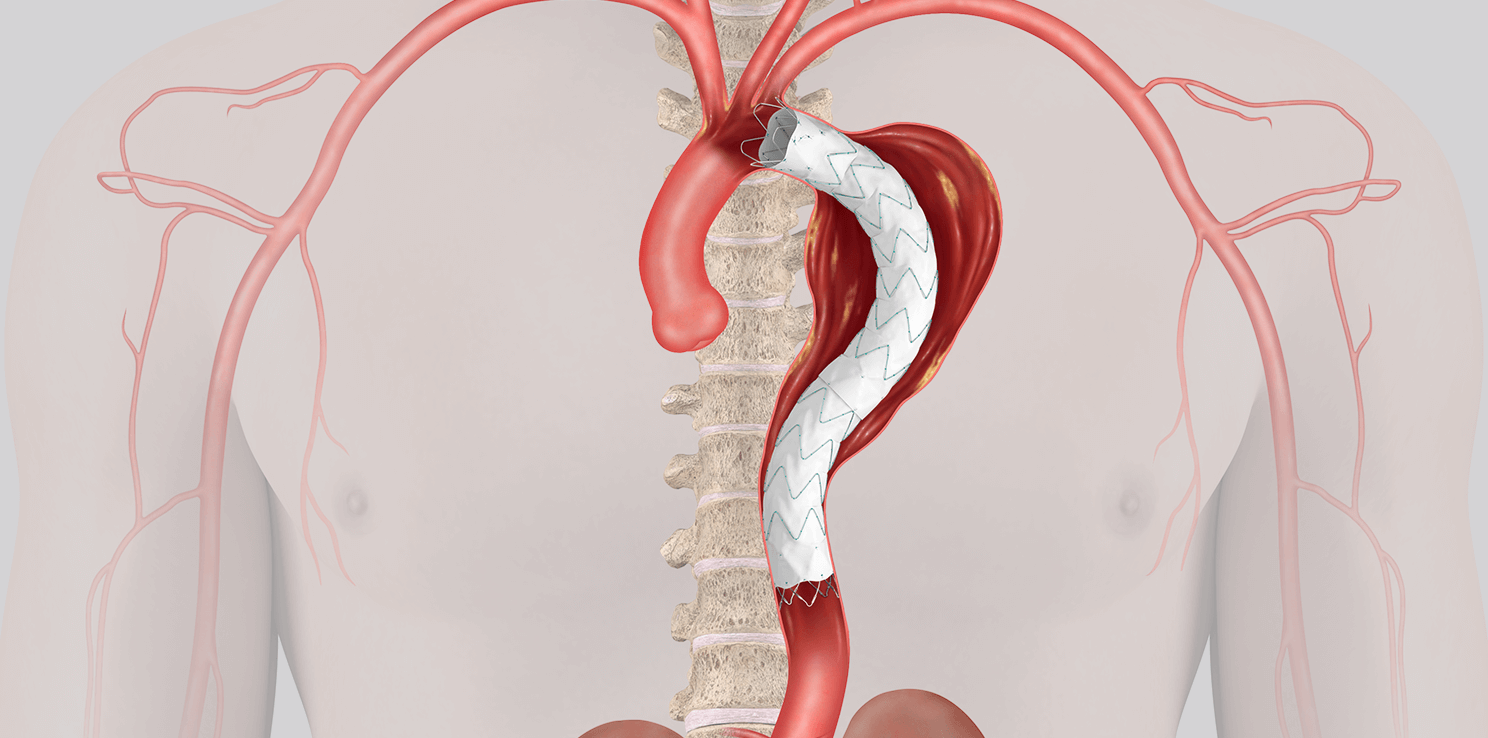 Thoracic aorta with endovascular graft — supplied illustration